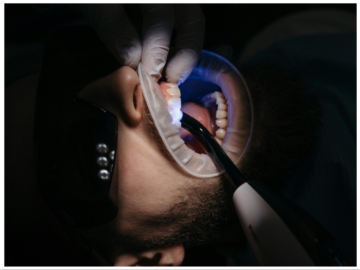 sbiancamento denti 3